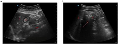 Effect of trans-nasal humidified rapid insufflation ventilatory exchange on reflux and microaspiration in patients undergoing laparoscopic cholecystectomy during induction of general anesthesia: a randomized controlled trial